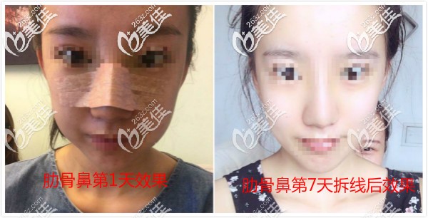 肋骨鼻一到七天图 肋骨鼻一到七天图