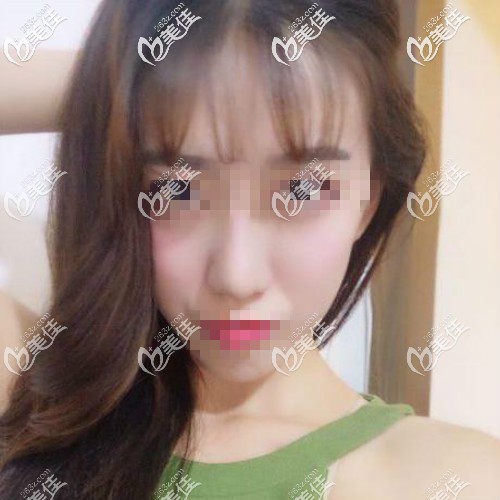 自体肋骨鼻两个月 自体肋骨鼻两个月