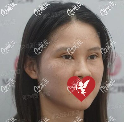 双眼皮开眼角眼综合术后8天拆线