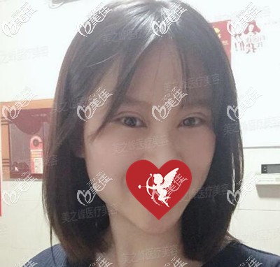 眼综合术后1个月时的恢复效果图