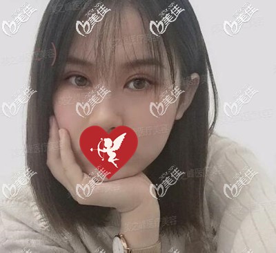 在长沙做眼综合术后2个月时的恢复效果照