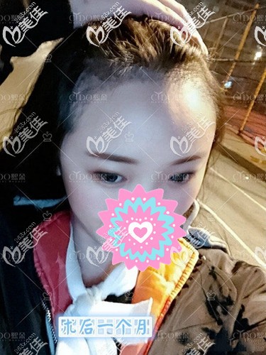 种植发际线有危险吗?来分享一下我做发际线种植后30天的生发经历过程