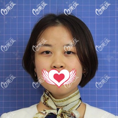 做双眼皮手术前的我 做双眼皮手术前的我