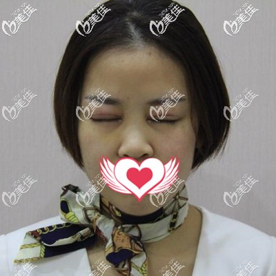 双眼皮术后一周拆线 双眼皮术后一周拆线