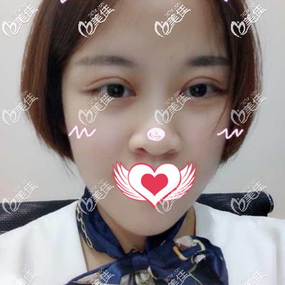 术后一个月效果分享 术后一个月效果分享