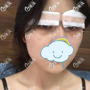 做完眼综合后的手术效果