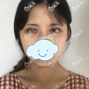 眼综合术后7天线条流畅