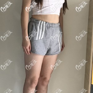 做大腿吸脂前 做大腿吸脂前