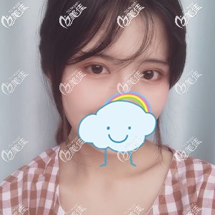 做切开双眼皮+开眼角术后45天肿胀渐消