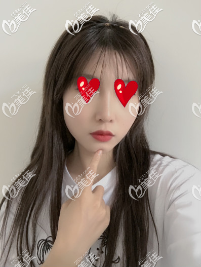 青岛诺美德假体隆鼻半个月的样子