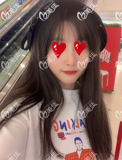 青岛诺美德假体隆鼻两个月的样子