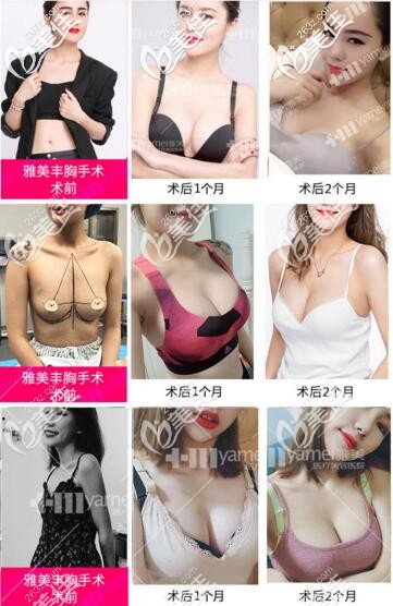 长沙雅美灵动丰胸真人案例