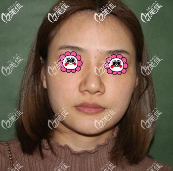 埋线提升术前照 埋线提升术前照