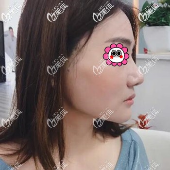 埋线提升面部术后当天 埋线提升面部术后当天