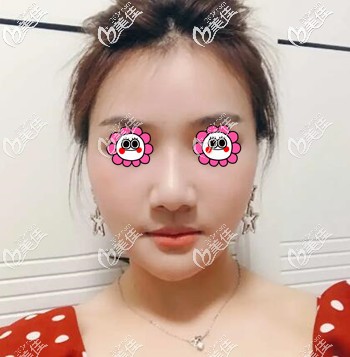 面部埋线提升术后1周效果照 面部埋线提升术后1周效果照