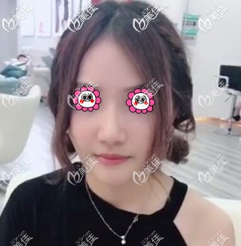 面部埋线提升术后半个月的恢复效果照 面部埋线提升术后半个月的恢复效果照