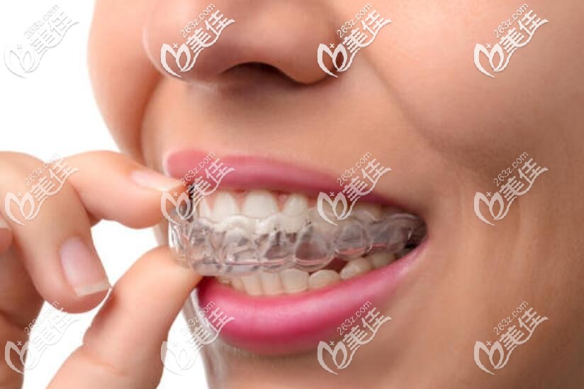 隐形牙套 隐形牙套