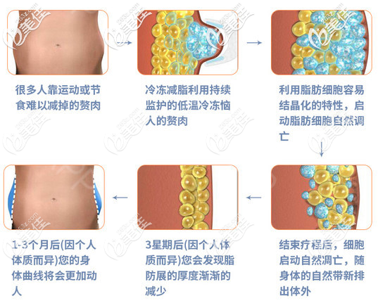酷塑冷冻溶脂的原理图片