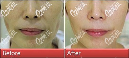 面部埋线提升后的对比