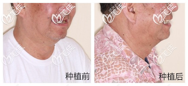 老爸做半口allon4种植牙前后对比照片 老爸做半口allon4种植牙前后对比照片