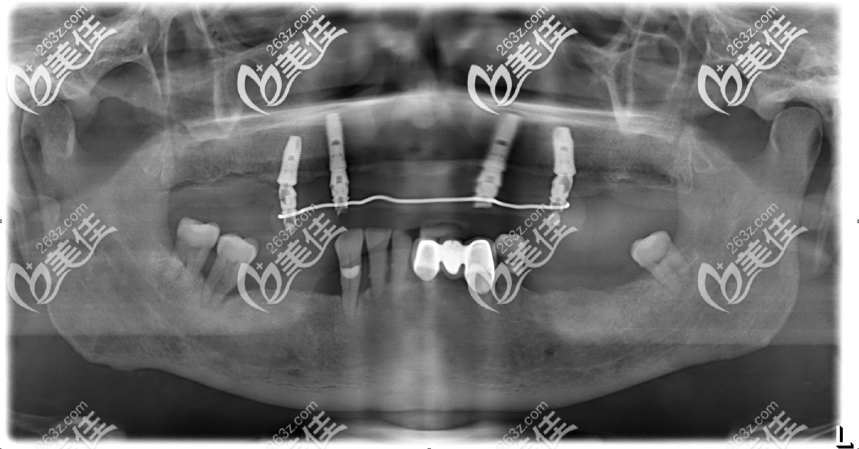 老爸在成都极光口腔种牙后的拍的片子 老爸在成都极光口腔种牙后的拍的片子