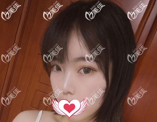 眼综合一个月没有出现疤痕增生