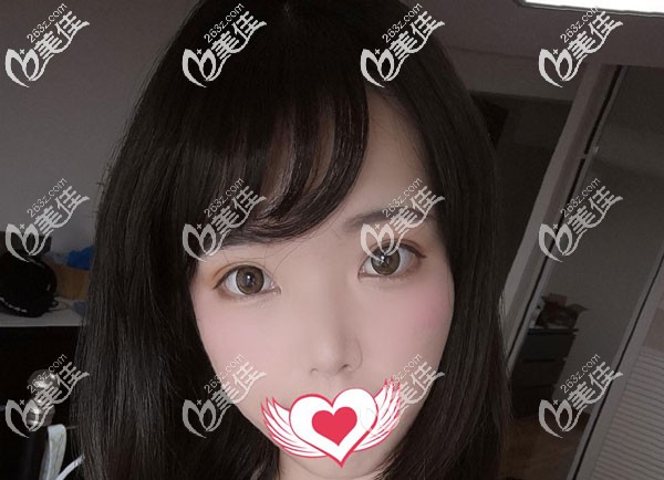 切开双眼皮2个月恢复的很自然