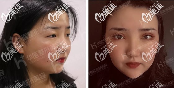 真人重睑切开、开内眦、提肌矫正15天效果