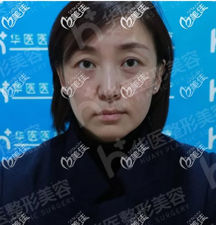 呼和浩特华医整形面部埋线提升前 呼和浩特华医整形面部埋线提升前