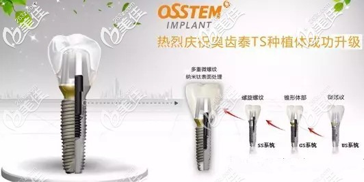 奥齿泰osstem ts3植体系列 奥齿泰osstem ts3植体系列