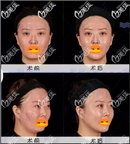 面部埋线提升+玻尿酸填充术前术后对比效果照