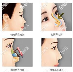 张明医生做鼻综合整形手术过程