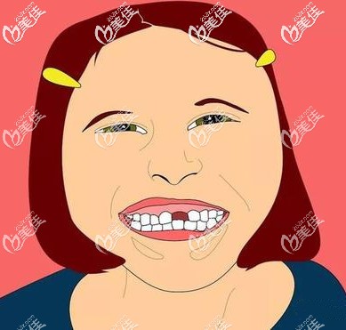 上门牙缺失真的好丑呀 上门牙缺失真的好丑呀