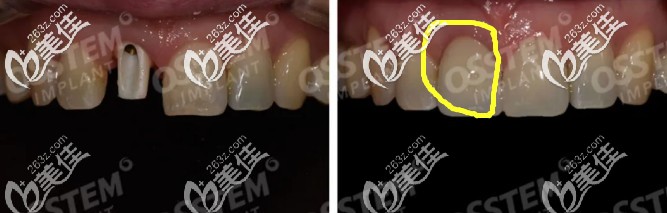 韩国奥齿泰种植牙前后效果图 韩国奥齿泰种植牙前后效果图