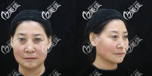 术前的我中下面部松弛明显 术前的我中下面部松弛明显