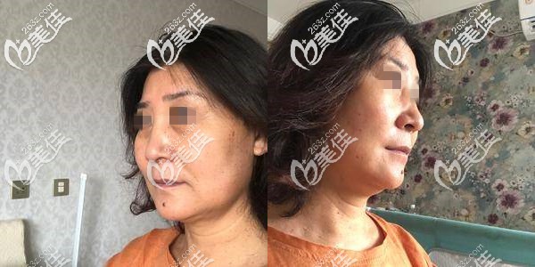 刚做完埋线提升术后肿胀,面部僵硬 刚做完埋线提升术后肿胀,面部僵硬