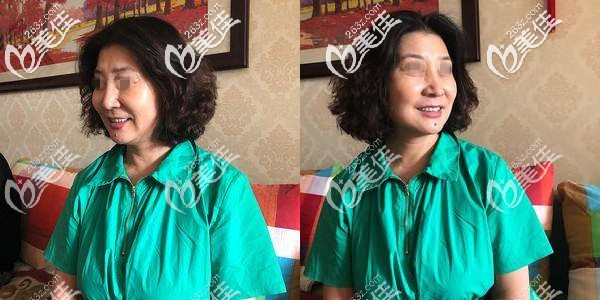 拿到这份苏州埋线提升价格后给你们看看我一边脸4根优雅斯大v线的效果