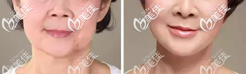 <!--<i data=20240703-sp></i>-->薛欣医生除皱案例