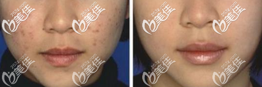 <!--<i data=20240703-sp></i>-->薛欣医生激光祛痘案例