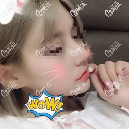 我找武汉匠星雷云飞做鼻综合恢复三个月效果照片 我找武汉匠星雷云飞做鼻综合恢复三个月效果照片