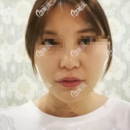 做肋骨鼻综合术前照片 做肋骨鼻综合术前照片