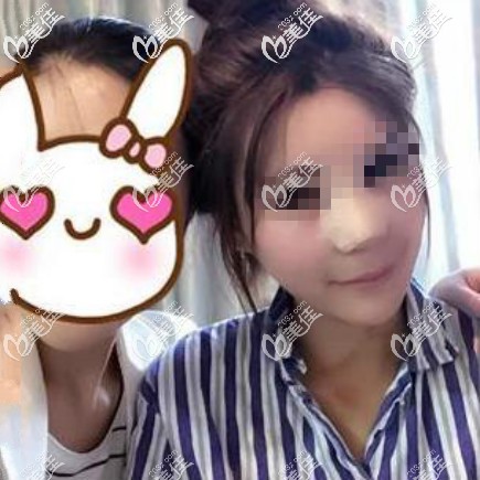 肋骨鼻综合术后第1天 肋骨鼻综合术后第1天