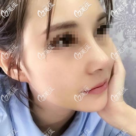 肋骨鼻综合第7天拍照效果 肋骨鼻综合第7天拍照效果