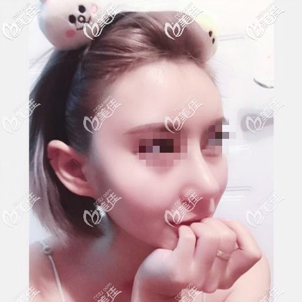 鼻综合15天恢复效果图片 鼻综合15天恢复效果图片