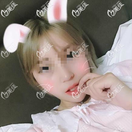 本人找武汉匠星雷云飞院长做肋软骨鼻综合变美日记!看完让你少走弯路！