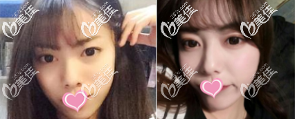 <!--<i data=20240703-sp></i>--><!--<i data=20240703-sp></i>-->庭切开双眼皮案例