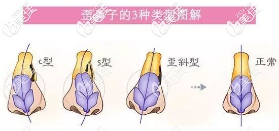 歪鼻的几种程度 歪鼻的几种程度