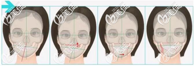 下颌骨正畸术原理 下颌骨正畸术原理