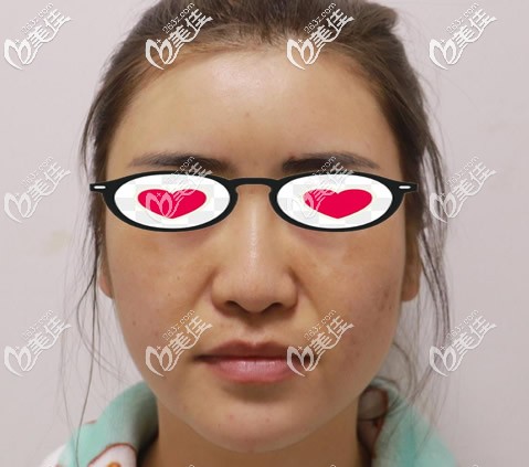 呼和浩特张高贵医疗美容门诊部张高贵术前照片1