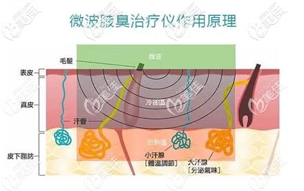 MiraDry微波原理 MiraDry微波原理